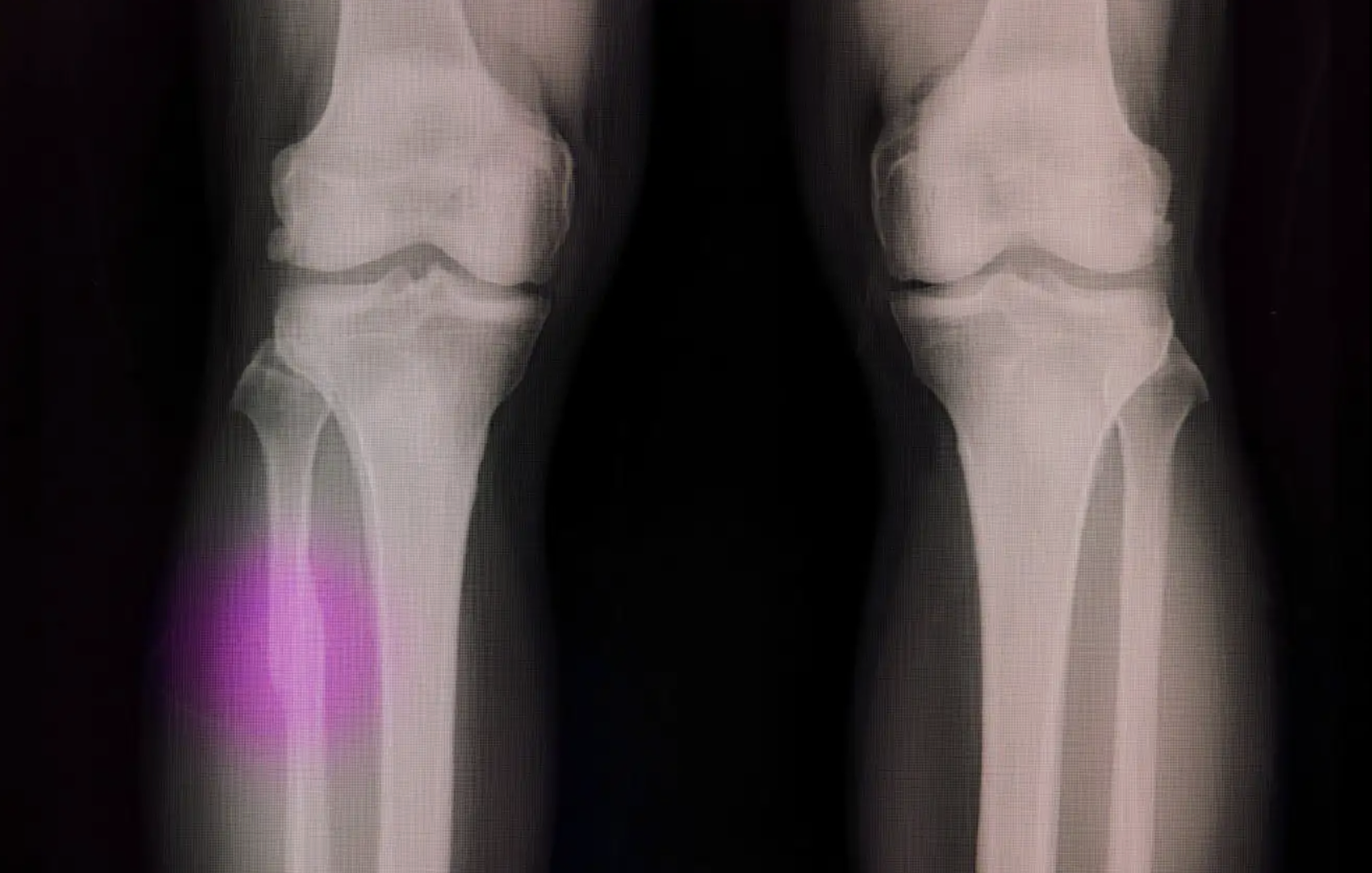 A modified hot glue gun can mend broken bones